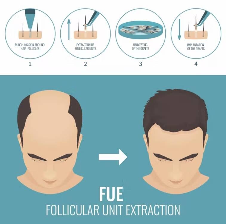 Implant do włosów FUE mikro si – Hair Care Vegan recenzja i cena